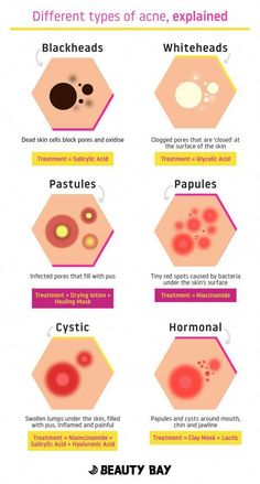 The 6 Different Types Of Acne, Explained - Beauty Bay Edited Skincare For Combination Skin, Different Types Of Acne, Types Of Acne, Image Skincare, روتين العناية بالبشرة, Oily Skin Care, Beauty Bay, Skin Care Routine Steps