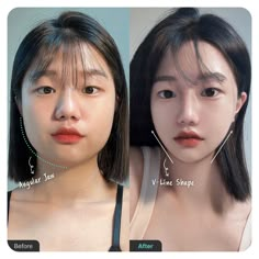 ✨Angular Jaw Surgery : Reduces the width of the lower face by shaving down the jaw bone to create a more slender,V-shaped JAW LINE  #gangnam #naturalplasticsurgery #beforeandafter #koreanaesthetic #nanafacialcontouring #nanaffs #nanafacecontour V Shaped Chin, V Shaped Jaw, V Shaped Face, V Line Face, V Shape Face