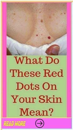 What do these red dots on your skin mean?What do these red dots on your skin mean? #SkinSpotMystery#RedDotDilemma  #SkinSymptomSOS  #MysteriousMarks #SkinSpotSolutions #RedDotRevelation  #SkinSpotInvestigation #DotsOnSkinExplained  #SkinSpotAwareness #RedDotDiagnosis Healthy Living Motivation, Women Health Care, Health Tips For Women, Grooming Tips, Breast Health, Healthy Liver, Liver Health