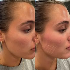 𝑨 𝒍𝒐𝒐𝒌 𝒀𝑶𝑼'𝑳𝑳 𝑳𝑶𝑽𝑬! Loss of check definition, or CONTOUR, can make you look tired or drained. NOT ANYMORE - release your inner radiance with @Restylaneusa CONTOUR. Filler For Cheek Enhancement ✨ Flexible Movement ✨ Natural-looking results ✨ Long Lasting Natural Fillers For Face, Cheek Fillers Round Face, Cheek Fillers Before And After, Cheek Filler Injection Sites, Cheek Filler Before And After, Cheekbone Filler, Cheeks Filler, Face Contouring Fillers, Cheek Fillers Before And After Face