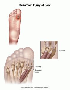 Summit Medical Group - Sesamoid Injuries of the Foot Body Knowledge, Plantar Fascitis, Karate Kata, Remedial Massage, Essential Oils For Pain, Foot Injury, Nurse Stuff, Health Information