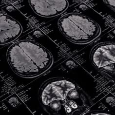 mri images show the different areas of the human's brain, including their structures and functions