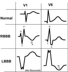 Lbbb Vs Rbbb, Ekg Rhythms, Cardiac Sonography, Cardiology Nursing, Ekg Interpretation, Np School, Medical Assistant Student, Paramedic School, Nurse Practitioner School