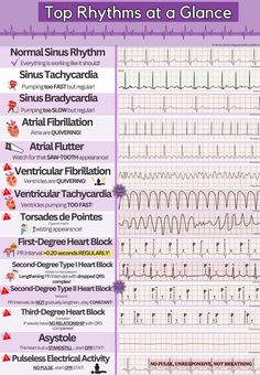 Rhythms at glance Ecg Rhythms Cheat Sheets, Junctional Rhythm, Dysrhythmias Nursing, Ekg Tech, Ekg Rhythms, Cardiac Sonography, Normal Sinus Rhythm, Ecg Interpretation