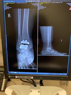 an x - ray image of a foot and ankle on a computer screen with other images