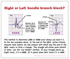 the right or left bundle branch block is shown in red and blue, with an arrow pointing