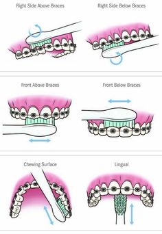 Dental Braces Colors, Braces Food, Braces Ideas, Braces Tips, Kedokteran Gigi, Brace Face