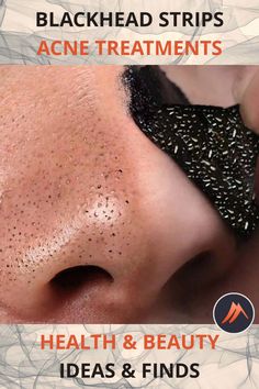 Nose Blackhead Removal Sticker Strips. Enjoy clear, blemish-free skin without scarring or damage using our sticker strips. Worldwide shipping. Remove Blackheads From Nose, Eyebrow Makeup Tutorial, Bad Acne, Remedies For Cough, Homecoming Makeup Ideas, Home Remedy For Cough, Skin Natural Remedies, Cold Sores, Cold Sores Remedies