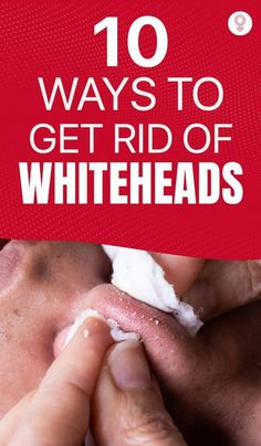 Are you looking for the best ways to get rid of whiteheads? Click here and check out the best at-home remedies and over-the-counter treatment options. Whitehead Removal Diy, How To Treat Whiteheads, How To Clear Whiteheads On Nose, How To Remove Whiteheads At Home, Removing White Heads From Face, Whiteheads Removal Remedies Home, Ways To Get Rid Of Blackheads, How To Treat White Heads On Face, How To Get Rid Of White Heads On Chin