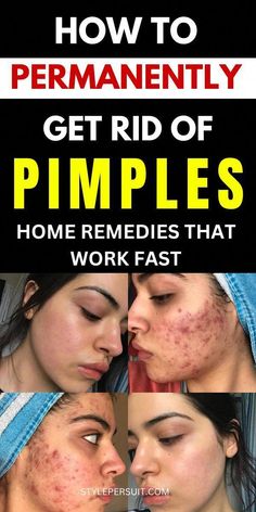 Pimple Remedies Overnight, Pimple Remedies, Pimples On Scalp, Face Pimples, Get Rid Of Pimples Overnight, Rid Of Pimples Overnight