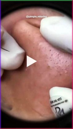 Personalize your skincare to suit your skin, lifestyle and environment! Simply take our 2-mins skin quiz to decode your skin and leave the hard work to us. All our products are made in Switzerland with 100% clean, cruelty- free and sustainably-sourced ingredients. Click to build your routine now💁‍♀️ Clear skin awaits! Satisfying Black Head Removal Video, Black Head Removal, Blackhead Remover Diy, Clear Blackheads