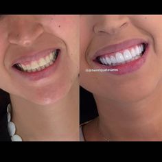 Transform your smile with Dr. Henrique Tavares! ✨ Cosmetic dentistry and smile makeovers for a confident, radiant you. Book your consultation today! #CosmeticDentistry #SmileMakeover #TeethWhitening #DentalHealth #DrHenriqueTavares