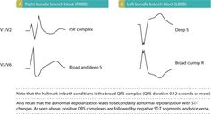 Left bundle branch block (LBBB): ECG criteria, causes, management – ECG & ECHO Left Bundle Branch Block, Ekg Nursing, Bundle Branch Block, St Elevation, Medical School Interview, Medical Things, Acute Coronary Syndrome, School Interview, Heart Stuff