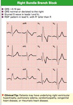 Ekg Interpretation Made Easy, Bigeminy Ekg, Ekg Lead Placement Cheat Sheets, 12 Lead Ekg Interpretation Made Easy, 12 Lead Ekg Placement, Ekg Lead Placement, Cardiovascular Nursing, Ekg Technician, Ekg Placement 12 Lead