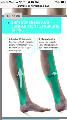 Kinesio tape for compartment syndrome Knock Knees, How To Help Nausea, Kinesio Taping, Kinesiology Taping, Shin Splints, Mobility Exercises, Leg Pain