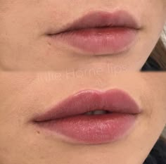 Lip Fillers Juvederm, Dermal Fillers Lips, Face Fillers, Botox Lips, Facial Fillers