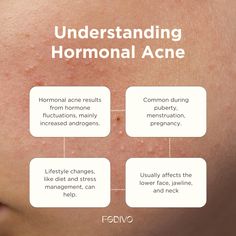 Acne Quotes, Skincare Post Ideas, Mom Community, Skincare Content, Blind Pimple, Acne Diet, Beauty Skin Quotes, Pimples Under The Skin, Skin Facts