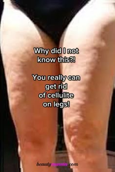 Wish i knew this before - simple natural remedies for legs with cellulite! How To Get Rid Of Leg Dimples, Tighten Thigh Skin, Leg Workout Before And After Pictures, Natural Skin Firming Remedies, Cottage Cheese Legs How To Get Rid Of, How To Get Rid Of Cellulight, Tighten Leg Skin, Saggy Legs Workout, Exercise To Remove Cellulites