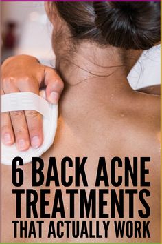 How to Treat Back Acne | Whether you experience occasional chest and back acne caused by sweat, heat, and/or hormonal changes, or you suffer from chronic cystic acne, one thing is for certain: you want to know how to get rid of back acne fast! While there are no known overnight cures, this post will help you understand what causes back acne, how you can prevent it, and the best treatments and remedies you can try at home, some of which are completely natural. Acne Map, Back Acne Causes, Body Acne Remedies, Get Rid Of Back Acne, Rid Of Back Acne, Acne Prone Skin Care Routine, Acne Face Map, Shoulder Acne, Acne Studios Scarf