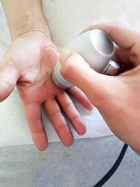 Dupuytren’s Contracture, Trigger Finger, and Carpal Tunnel Syndrome: What’s the Difference? | Greater Chesapeake Hand Specialists Dupetryns Contracture, Thumb Pain Relief, Obese Pregnancy, Dupuytren's Contracture, Median Nerve, Trigger Finger, Hand Pain, Fluid Retention, Carpal Tunnel