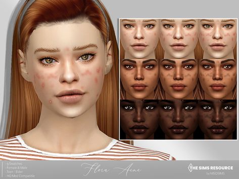 The Sims Resource - Flora Acne Acne Mod Sims 4, Sims 4 Cc Skin Genetics, Sims 4 Cc Mods Skin, Sims 4 Facial Presets, Pimples Sims 4 Cc, Sims 4 Cc Acne Maxis Match, Facial Features Sims 4 Cc, Sins 4 Skin Details, The Sims 4 Acne Cc