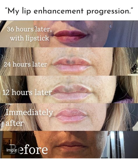 Juvederm Lips, Injectables Fillers, Lip Filler, Lip Enhancement, Lip Serum, Choppy Hair, Diy Lips, Short Choppy Hair, Lip Injections