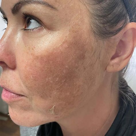 My Skin Looks Worse After Chemical Peel - Is That Normal? Facial Chemical Peel Before And After, Chemical Peel Aesthetic, Chemical Peel Before And After, Chemical Peel Benefits, Diy Chemical Peel, Chemical Peel Results, Botox Business, Chemical Face Peel, Peeling Face