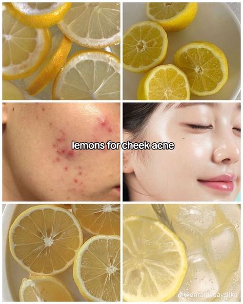 Cheek Acne, Foods For Clear Skin, Beginner Skin Care Routine, Foods For Healthy Skin, Natural Face Skin Care, Good Skin Tips, Body Acne, Perfect Skin Care Routine, Healthy Skin Tips