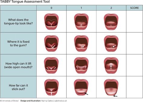 Cleft Lip And Palate Awareness, Cleft Lip And Palate, Health Care Assistant, Feeding Therapy, Cleft Lip, Chiropractic Wellness, Dental Marketing, Baking Basics, Tongue Tie