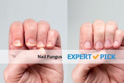 Learn causes, symptoms, and treatments for nail fungus to keep your nails healthy and infection-free. Nail Fungus Remedies, Fungi Pictures, Fingernail Fungus, Nails Healthy, Nail Fungus Remedy, Nail Infection, Fungal Nail, Nail Oil, Young Living Oils