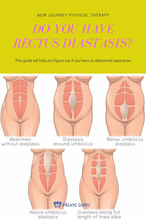 Do I have rectus diastasis? How to know if you have a gap and to start the recovery process Diastasis Recti Looks Like, How Do You Know If You Have Diastasis Recti, How To Check For Diastasis Recti, Correcting Diastasis Recti, How To Fix Diastasis Recti Years Later, Severe Diastasis Recti, Diastis Recti Before And After, How To Avoid Diastasis Recti, Ab Separation Diastasis Recti Exercise