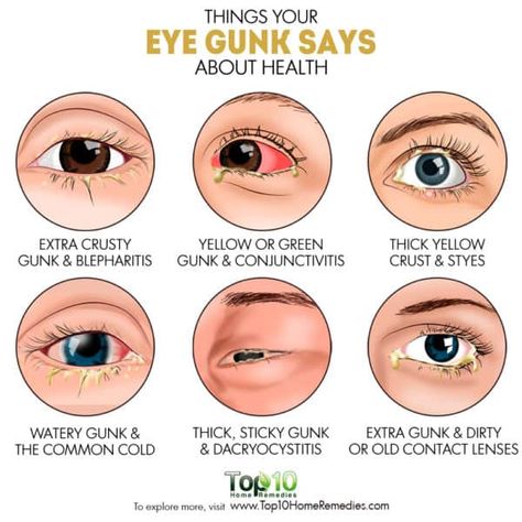 things your eye gunk says about your health Optician Training, Eye Health Facts, Optometry Education, Eye Health Tips, Remedy For Sinus Congestion, Pinkeye Remedies, Eye Health Remedies, Home Remedies For Sinus, Eyes Care