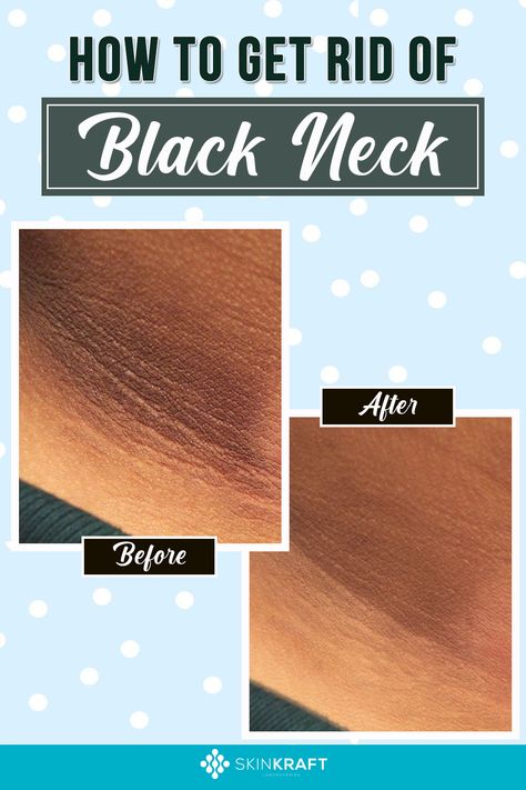 How To Get Rid Of Black Neck How To Lighten Dark Neck Skin, Get Rid Of Dark Neck Fast, How To Get Rid Of Dark Spots On Knees, How To Treat Dark Neck, Neck Discoloration Remedies, How To Get Rid Of Black Neck Fast, How To Clean Dark Neck, Black Neck How To Get Rid Of, Hyperpigmentation On Neck