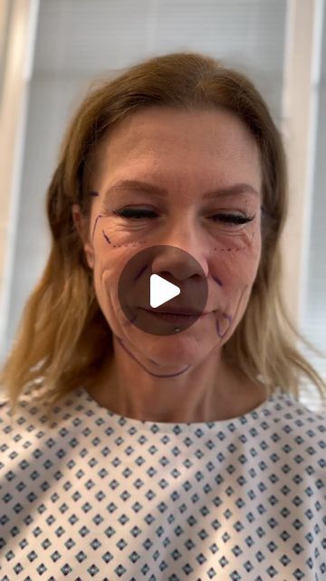 Plastic Surgery Before And After, Funny People After Surgery Videos, Breast Lift Surgery, Failed Plastic Surgeries, Body Plastic Surgery, Facelift Surgery, Plastic Surgery Fail, Transgender Surgeries, Face Lift Surgery