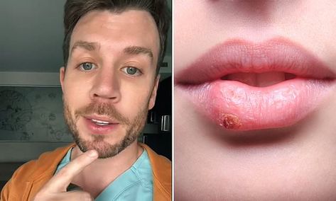 Doctor reveals clever hack to make your cold sores vanish quicker Coldsore Remedies Quick How To Get Rid, Coldsore Remedies Overnight, Cover Up Cold Sore, Cold Sore Remedy Quick Overnight, Cold Sore Scab, Cold Sore Remedy, Cold Sore Remedy Fast, Cold Sore Remedy Overnight, Cold Sore Stages