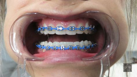 Power Chain Braces Colors Ideas, Power Chain Braces Colors, Braces Colors Ideas Power Chains, Braces Power Chain, Powerchain Braces Color, Sky Blue Braces, Royal Blue Braces, Colored Braces, Power Chains