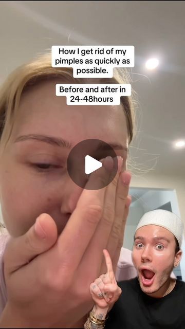 How To Get Rid Of Pimples Overnight, Cystic Acne Popping, Matt Randon, Diy Botox, What Causes Pimples, Zit Remedy, Botox Alternative, How To Reduce Pimples, Prevent Pimples