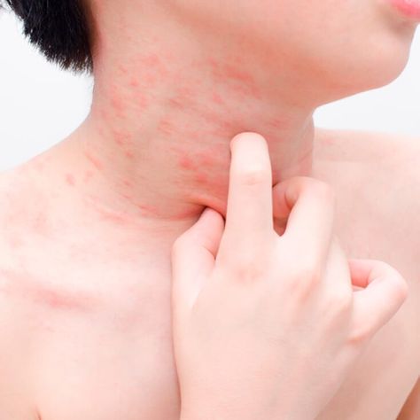 Relieve Your Child’s Scarlet Fever Rash: 10 Natural Treatments by @draxe Fever Rash, Common Skin Rashes, Strep Throat Remedies, Red Rash, Remedies For Tooth Ache, Itchy Rash, Skin Rashes, Heat Rash, Skin Disorders