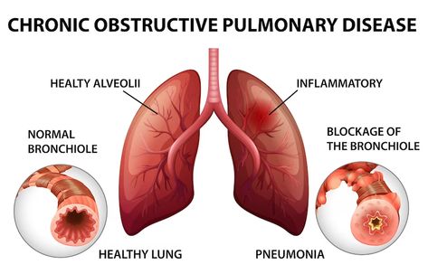 Home Remedies For Bronchitis, Arterial Blood Gas, Nclex Questions, Lung Conditions, Lung Transplant, Healthy Lungs, Chronic Obstructive Pulmonary Disease, Pulmonary Disease, Respiratory Infection