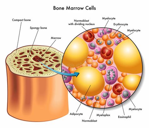 Bone marrow cells. Medical illustration of the composition of bone marrow cells , #AFFILIATE, #cells, #marrow, #Bone, #Medical, #bone #ad Myeloproliferative Neoplasms, Blood Disorders, Pelvic Bone, White Blood Cells, Bone Marrow, Blood Cells, Safety First, Anatomy And Physiology, Bone Health