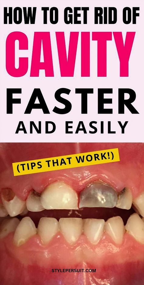 Explore effective and natural remedies to tackle cavities right from the comfort of your home. This guide from StylePersuit delves into holistic approaches that promote oral health without the need for harsh chemicals. Learn how simple ingredients and lifestyle changes can make a significant difference in maintaining a healthy smile. Whether you're looking to prevent cavities or manage existing ones, these tips offer a gentle yet powerful alternative to conventional treatments. Embrace a more natural path to dental care and keep your teeth strong and vibrant. Natural Cavity Remedy, Home Remedies For Cavities, Natural Remedies For Cavities, Cavity Remedy, Reverse Cavities, Tooth Decay Remedies, Natural Path, Natural Mouthwash, Heal Cavities