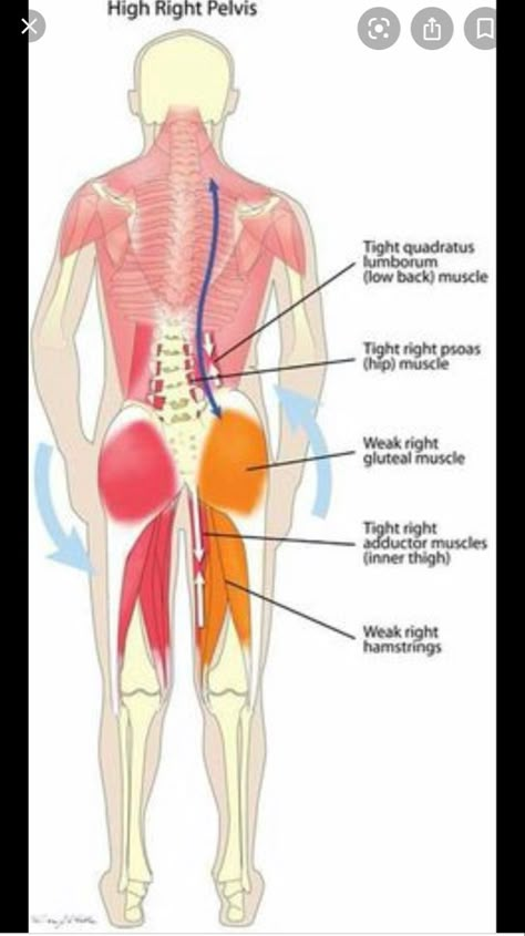 Misaligned Pelvis, Punkty Spustowe, Psoas Release, Tight Hip Flexors, Muscle Imbalance, Spine Health, Muscle Anatomy, Simple Health, Hip Muscles