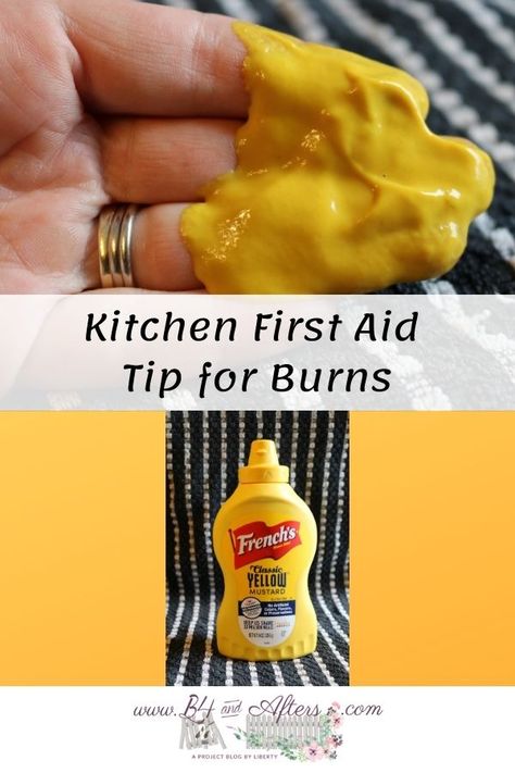 How To Help A Burn On Hand, Home Remedy For Burns Hands, Burn Remedies Hand, Diy Burn Relief, Burn Relief Hand, What To Put On Burns On Skin, Hand Burns Skin, Burn Remedies, Blister Remedies