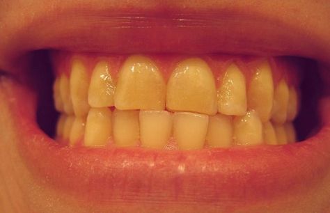 5 Ways to Get Rid of Yellow Teeth Get Rid Of Yellow Teeth, Make Teeth Whiter, Coffee Stain Removal, Homemade Mouthwash, Plaque Teeth, Discolored Teeth, Teeth Whitening Remedies, Tips For Acne, Yellow Teeth