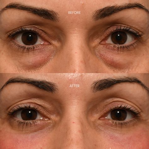 Post-op from a lower blepharoplasty and contour TRL. Our patient shows stunning results just 1 month after her surgery! Contact us today! 212.229.1100 info@eskmd.com #drkwak #dredwardskwak #plasticsurgery #plasticsurgeon #cosmeticsurgery #cosmeticsurgeon #facialaesthetics #facialplastics #antiaging #beforeandafter #beforeafter #bleph #blepharoplasty #eyelid #eyelids #eyes #darkcircles #lowerbleph #lowerblepharoplasty #medspa #beauty Facial Plastic Surgery, Facial Aesthetics, Facial Plastic, Post Op, Med Spa, Plastic Surgeon, Cosmetic Surgery, 1 Month, Dark Circles