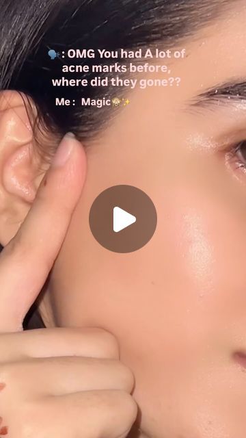 Zarnab🤍 | Yes its true , Acne marks ko ap hamesha k leay by by kr skty and can get glass skin , srf remedies use kr k😍♥️✨  I started series of daily... | Instagram Remedies For Acne Marks, Products For Acne Marks, Acne Marks Remedies, Acne Pictures, Pimples On Scalp, Acne Prone Skin Care Routine, Get Glass Skin, Boiled Rice, Anti Aging Skincare Routine