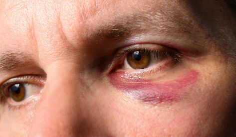 7 BEST HOME REMEDIES FOR BLACK EYES We refer to an eye bruise as a black eye. When blood collects behind the skin around the eyes, it occurs. Black eyes typically form after a head or face injury, however, they can also appear following facial surgery. https://elnodiacademy.com/black-eye/ Black Eye Injury Reference, Face Bruising, Gretchen Costume, Micah Bell, Overnight Remedies, Wound Makeup, Eye Injury, Head Wound, Facial Surgery