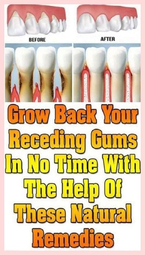 You have me if you need me. Spectacular information! Remedies For Tooth Ache, Strong Teeth, Healthy Teeth And Gums, Dental Health Care, Gum Recession, Ways To Heal, Teeth Health, Oral Care Routine, Health Care Tips