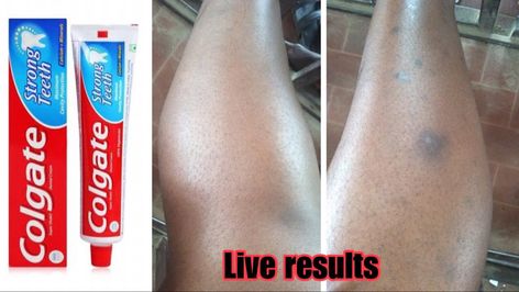 Leg Hyperpigmentation, Leg Scars, Dark Spots On Legs, Getting Rid Of Scars, How To Fade, Spots On Legs, Acne Overnight, Acne Free Skin, Dark Spots On Face