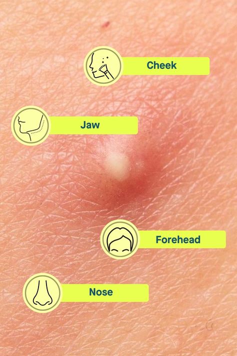 Cheek Breakouts, Underground Pimple, Serums For Acne, Pustules Acne, What Causes Pimples, Jawline Acne, Acne Face Map, Nose Pimples, Painful Pimple